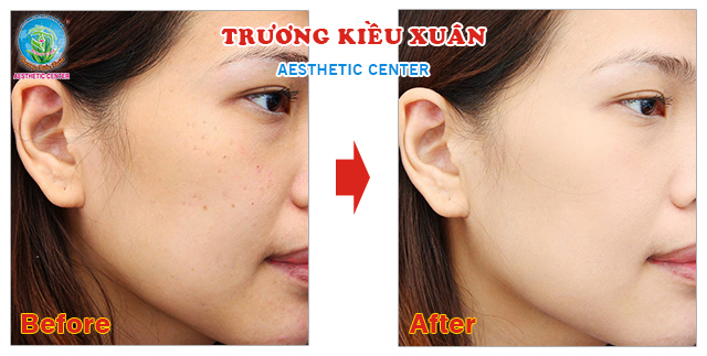 "Kết quả khách hàng sau khi chăm sóc da mặt