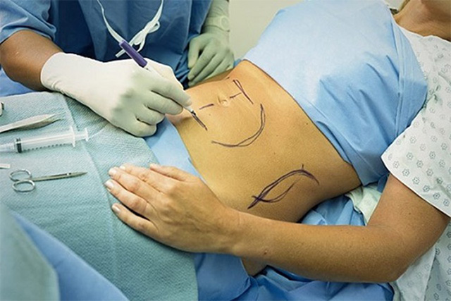 Bác sĩ đánh dấu vùng mỡ cần loại bỏ trước khi tiến hành giảm béo bụng