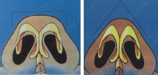 Hình ảnh 3D về phẫu thuật nhu nhỏ đầu mũi