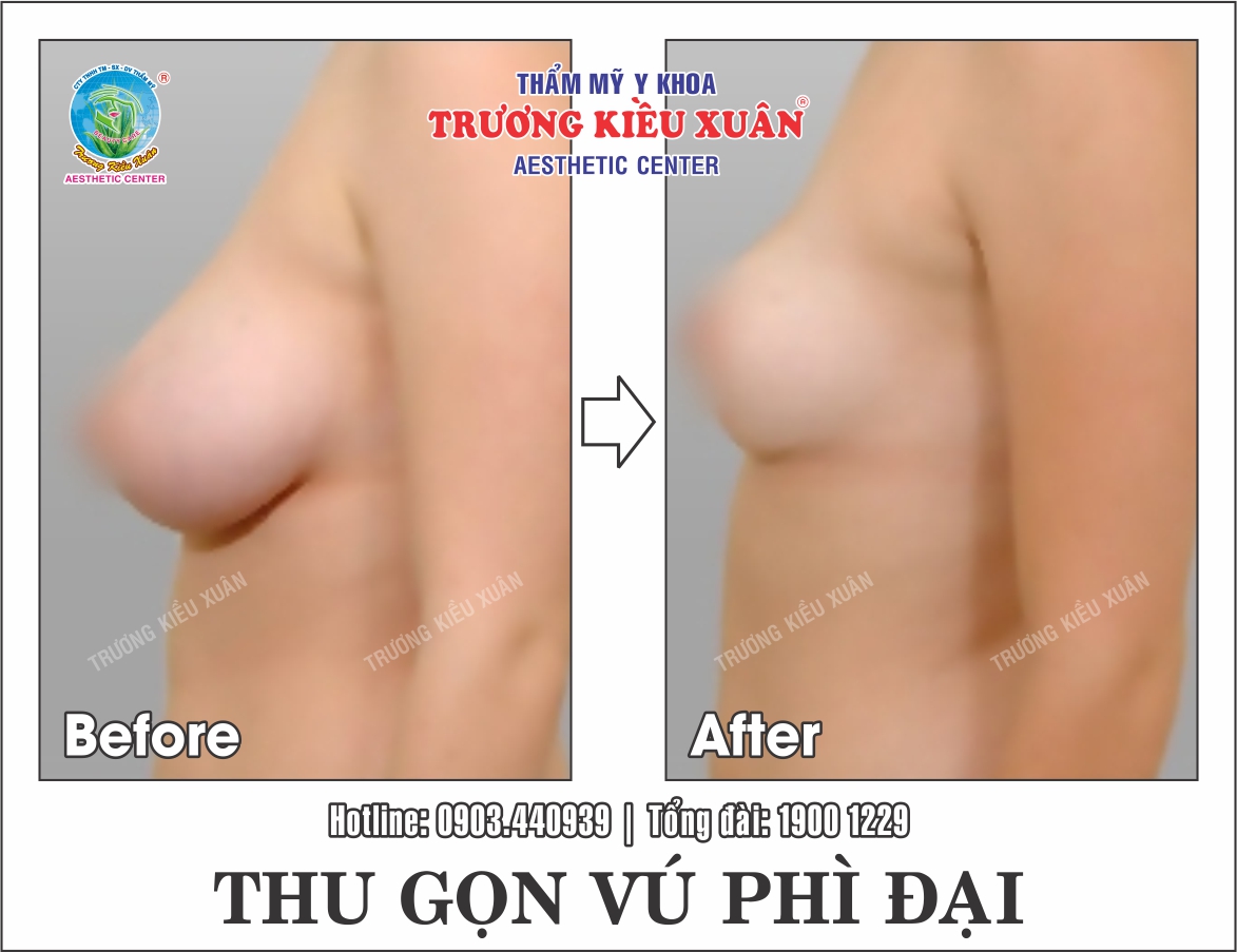 Hình ảnh trước và sau khi thu nhỏ ngực phì đại tại Trương Kiều Xuân