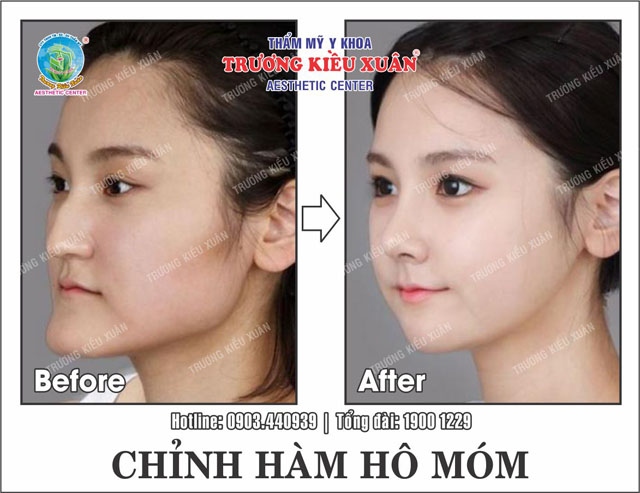 chinh ham ho mom (truoc-sau)