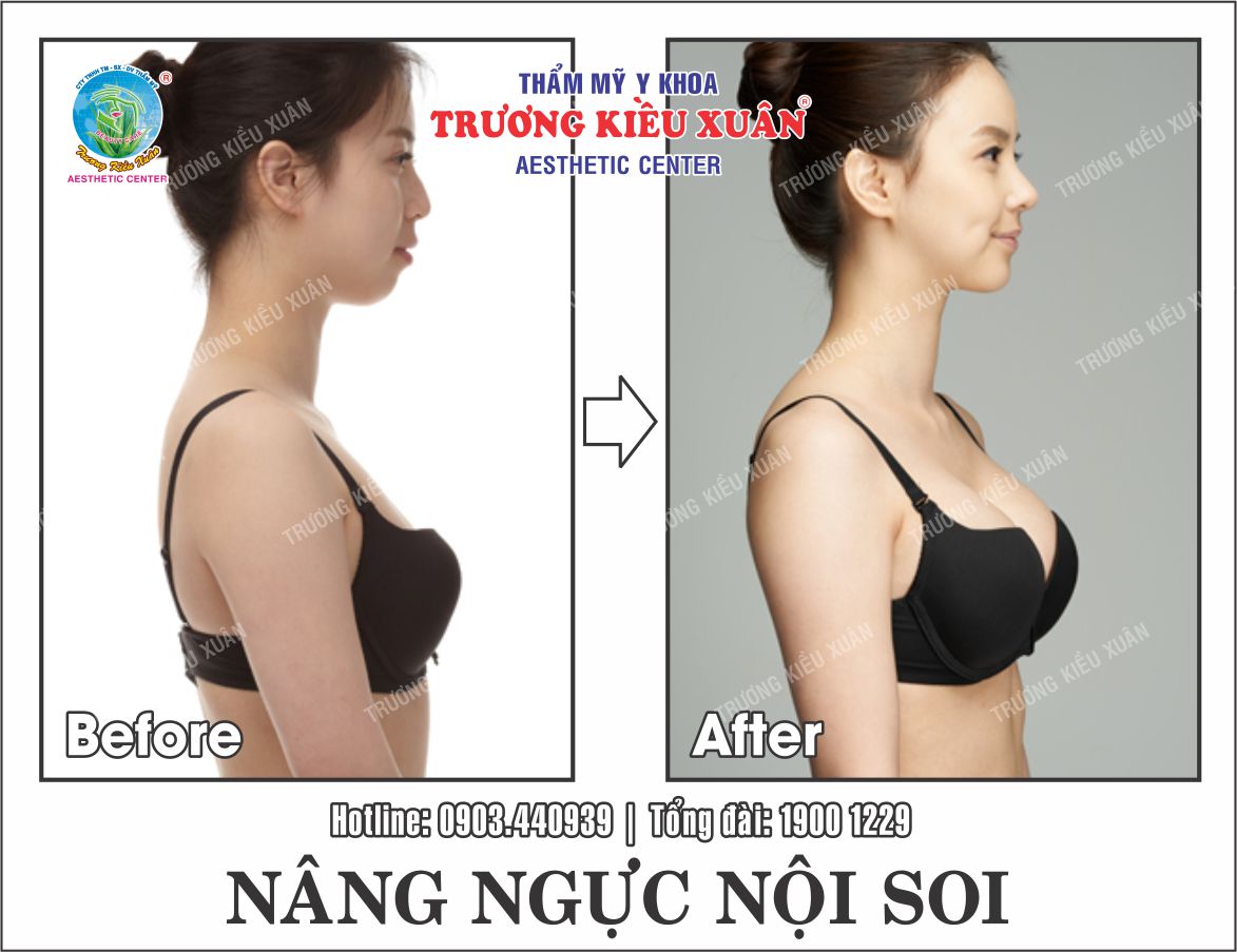 nang nguc noi soi (truoc-sau)