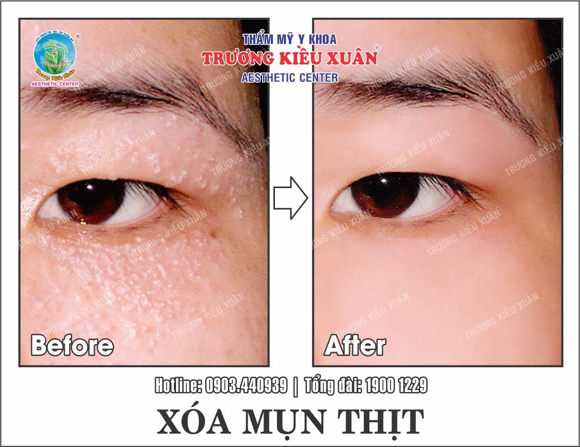 xoa mun thit (truoc-sau)