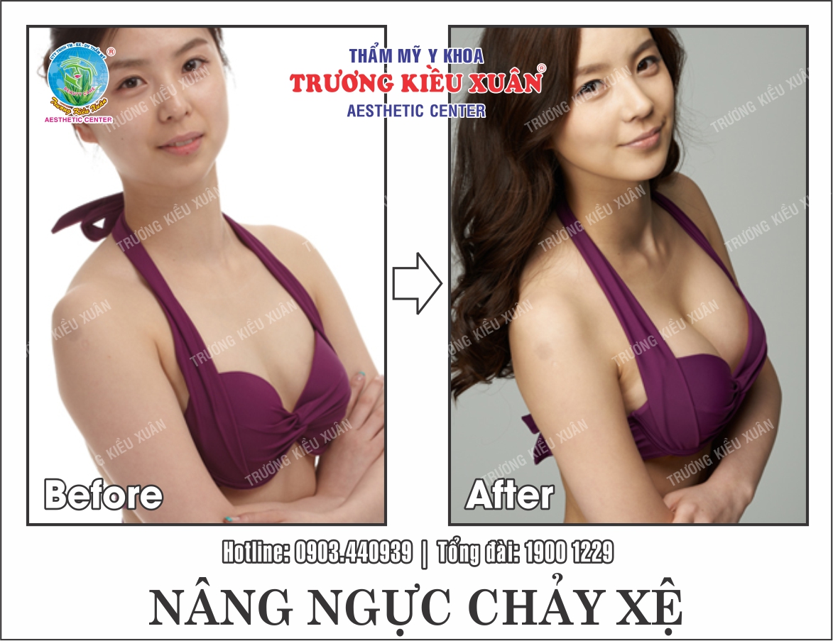 Hình ảnh khách hàng trước và sau nâng ngực chảy xệ