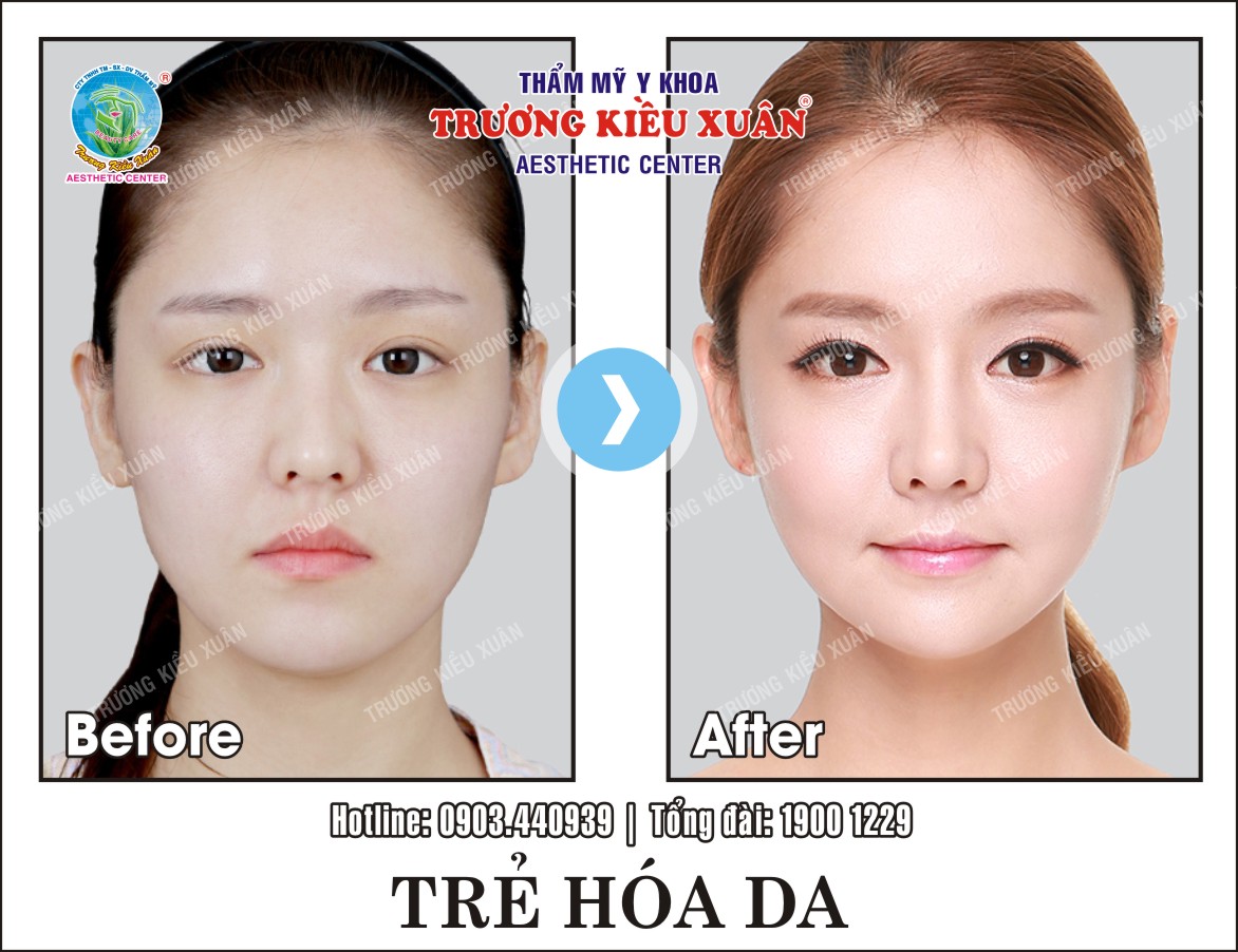 Hình ảnh khách hàng trước và sau khi trẻ hóa da tại Trương Kiều Xuân