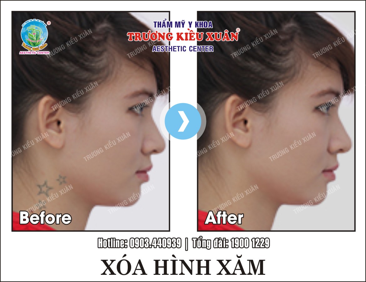 Hình ảnh khách hàng trước và sau khi xóa xăm tại Trương Kiều Xuân