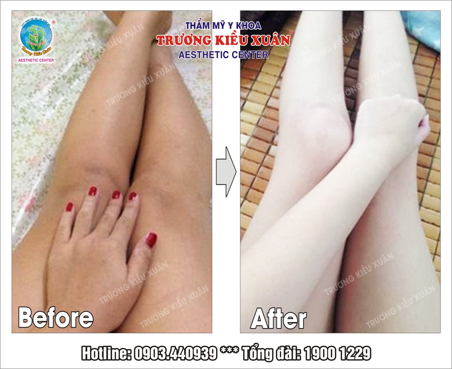 Hình ảnh khách hàng trước và sau khi tắm trắng