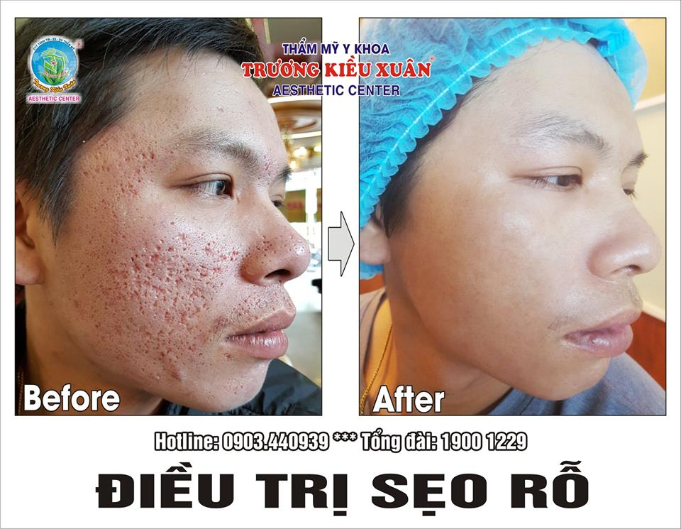 SIÊU MÀI MÒN KIM CƯƠNG-TRỊ SẸO RỖ TẠI BIÊN HÒA