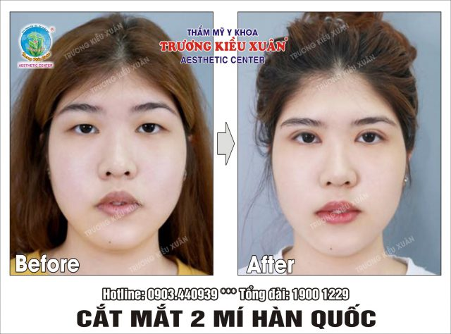 tạo mắt 2 mí bằng chỉ 