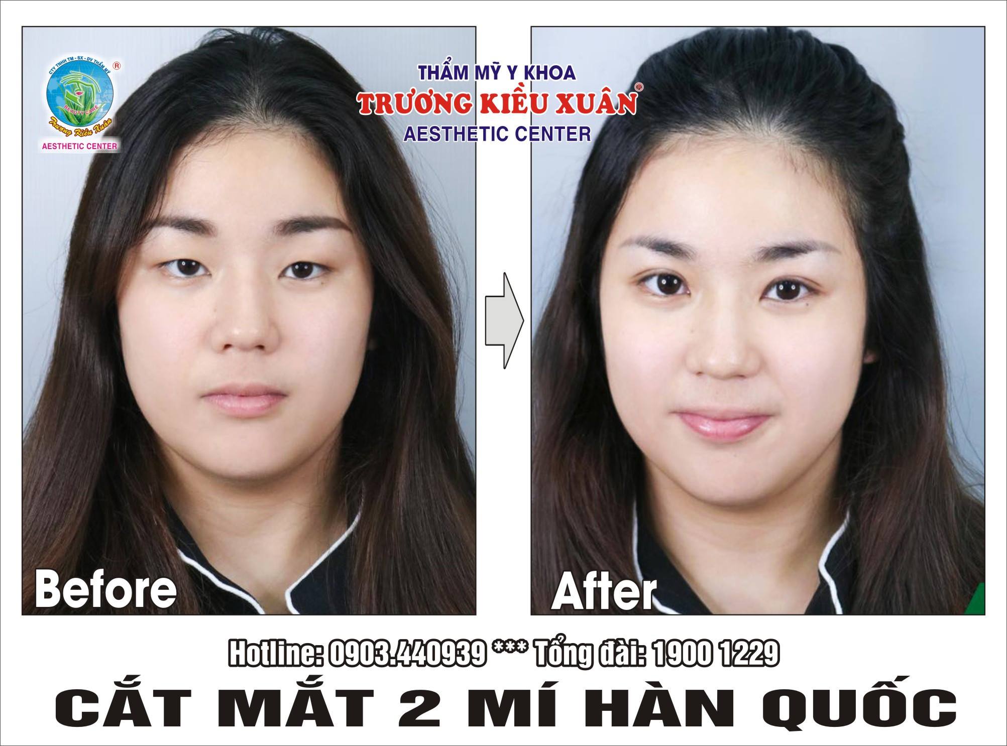 tạo mắt 2 mí tại nhà