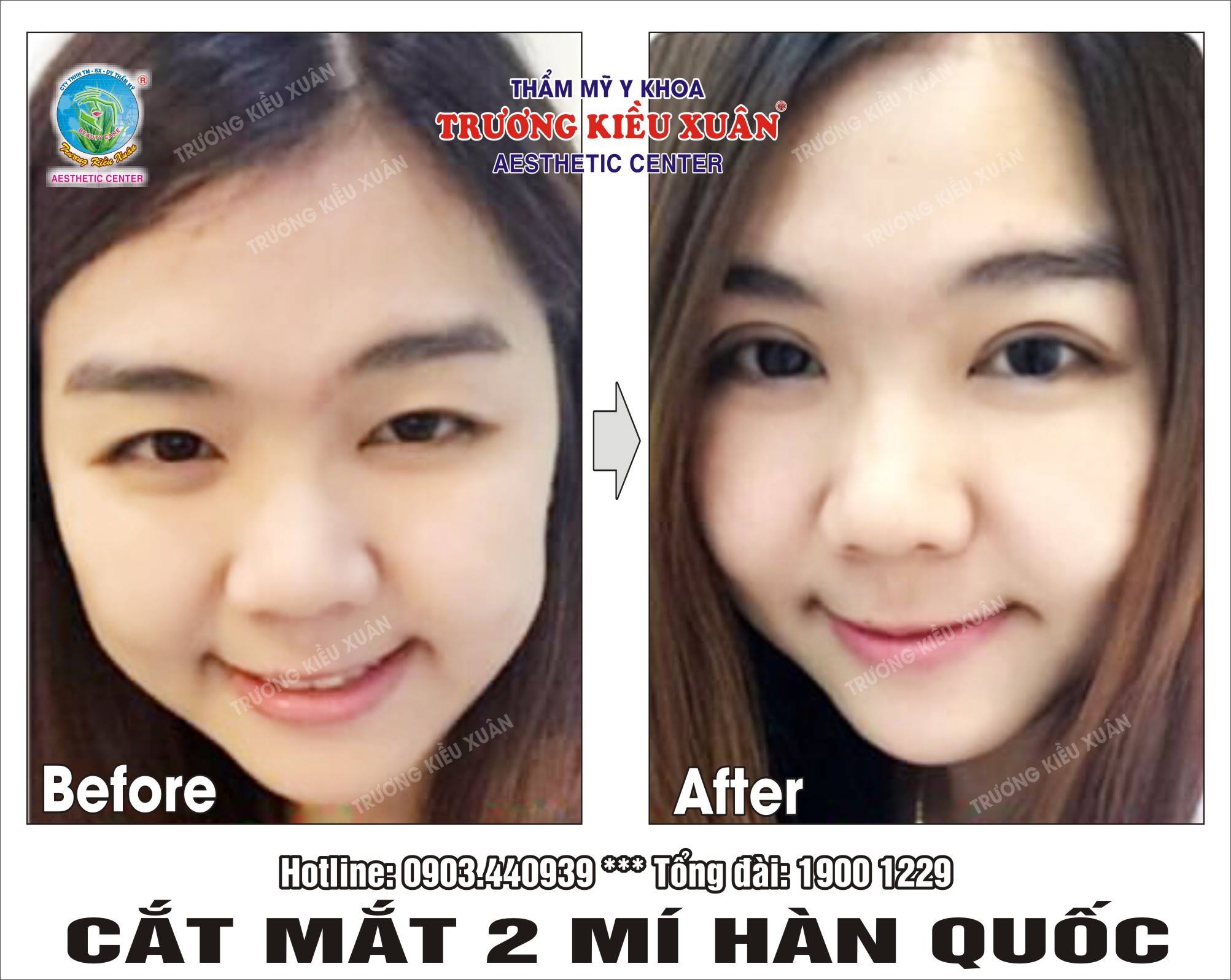 làm mắt 2 mí giá bao nhiêu