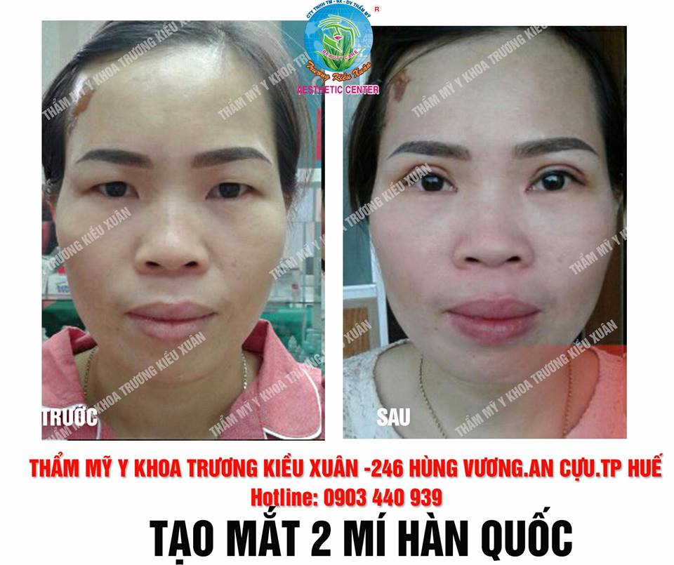 tạo mắt 2 mí bằng chỉ 