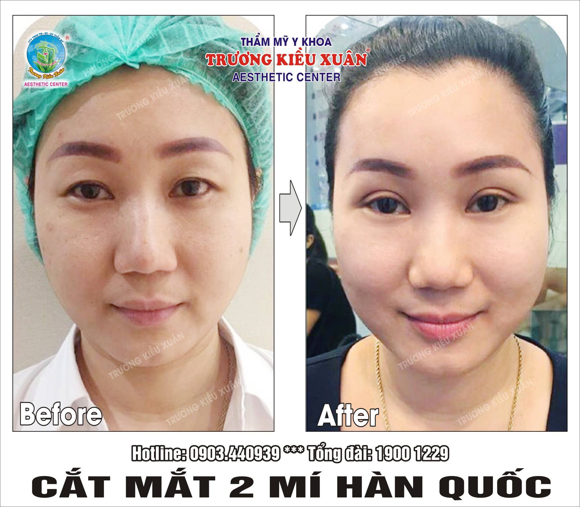 nhấn mí hàn quốc có đau không