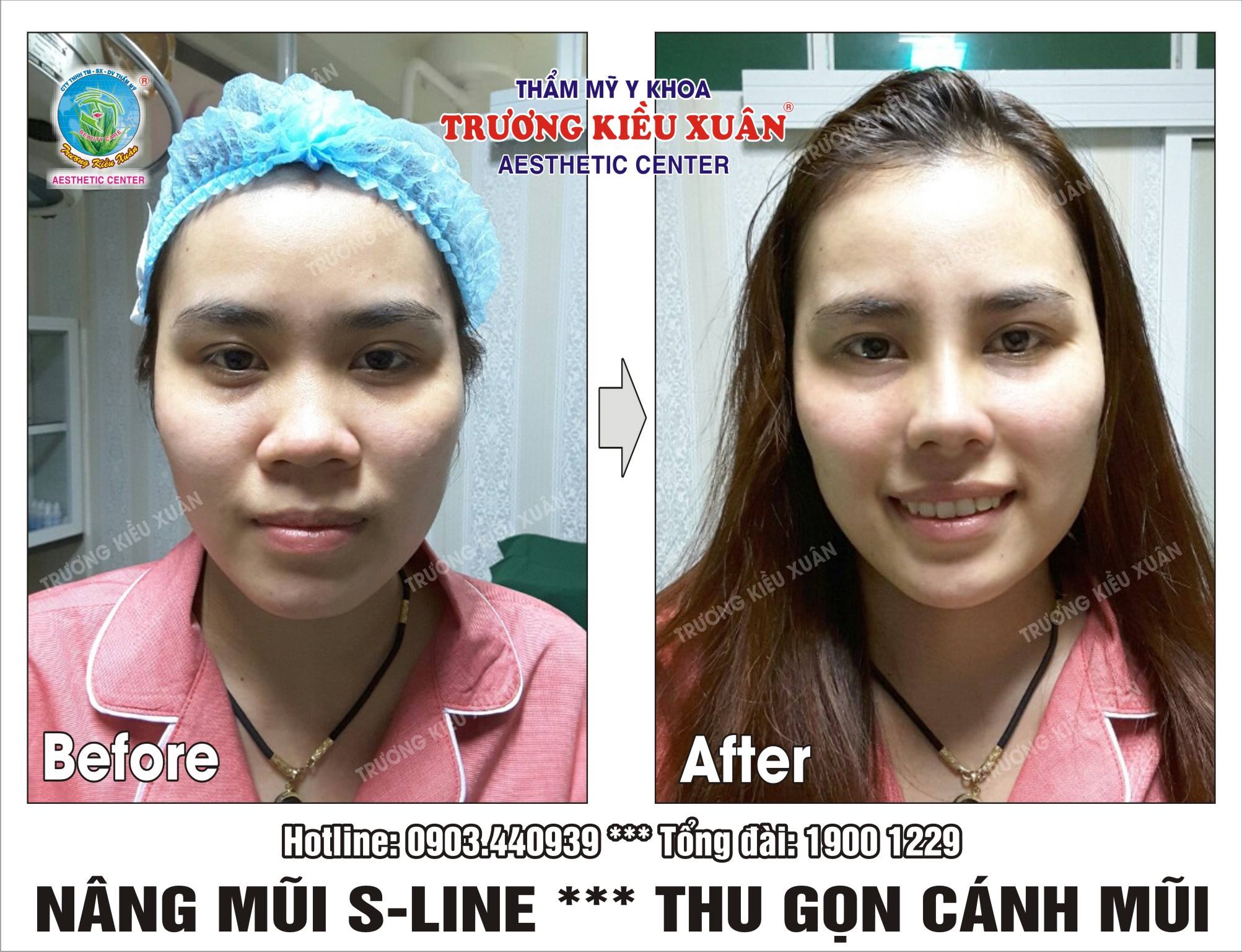 thu gọn đầu mũi ở đâu tốt