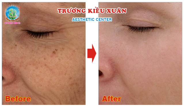 Hình ảnh của khách hàng sau khi sử dụng công nghệ trẻ hóa da mới nhất Hình ảnh của khách hàng sau khi sử dụng công nghệ trẻ hóa da mới nhất