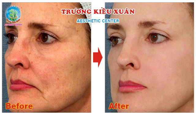 Hình ảnh của khách hàng sau khi sử dụng công nghệ trẻ hóa da mới nhất Hình ảnh của khách hàng sau khi sử dụng công nghệ trẻ hóa da mới nhất