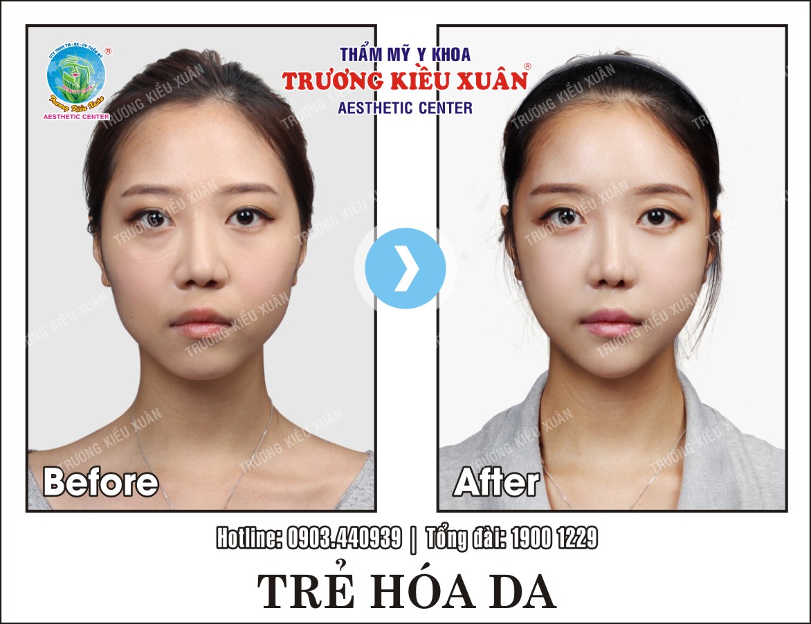 Hình ảnh khách hàng trước và sau khi trẻ hóa da tại Trương Kiều Xuân Hình ảnh khách hàng trước và sau khi trẻ hóa da tại Trương Kiều Xuân