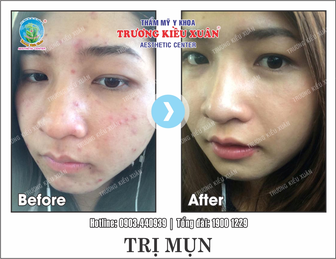 tre1bb8b-me1bba5n-1-truoc-sau trị mụn 1 (truoc-sau)