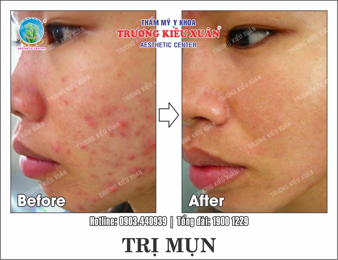 tri-mun-truoc-sau-copy tri mun (truoc-sau) - Copy